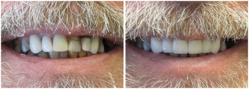 before_after1-md