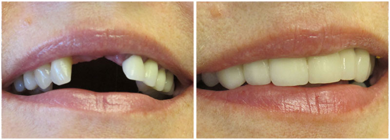 before_after2-md