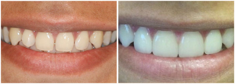 before_after3-md