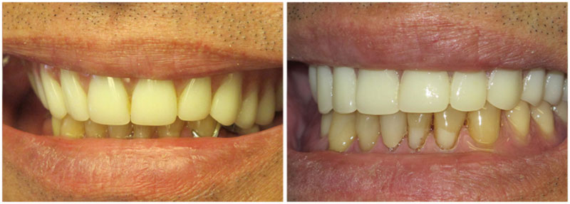 before_after4-md
