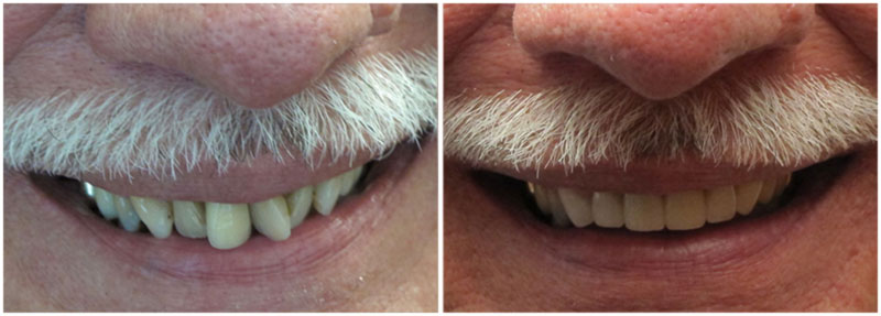 before_after8-md